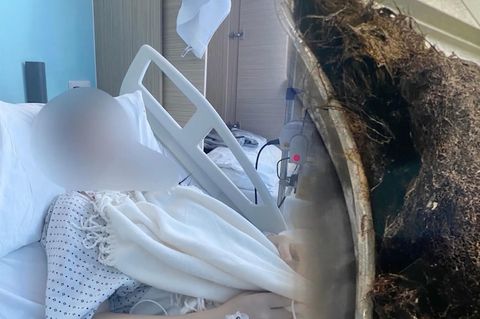 Ärzte entfernen riesigen Haarklumpen – 14-Jährige leidet an Rapunzel-Syndrom