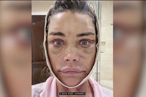 Denise Richards zeigt erstmals teuren Facelift &ndash; inklusive Vorher-Nachher-Bildern